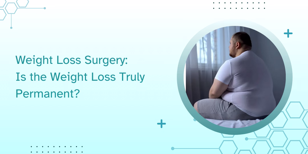 Weight Loss Surgery: Is the Weight Loss Truly Permanent?